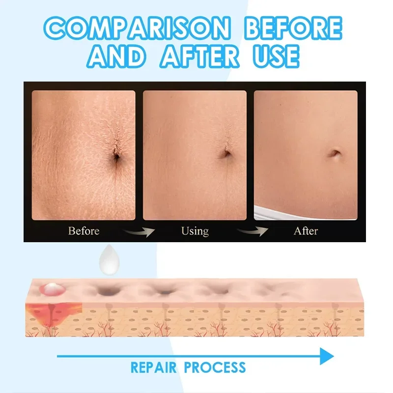 Stretch Marks Remover Cream Pregnancy Maternity Body New Old Stretch Remove Marks Lifting Firming Increase Elasticity Of Skin