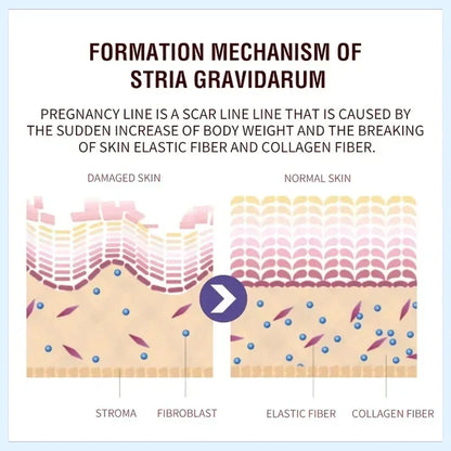 Stretch Marks Remover Cream Pregnancy Maternity Body New Old Stretch Remove Marks Lifting Firming Increase Elasticity Of Skin