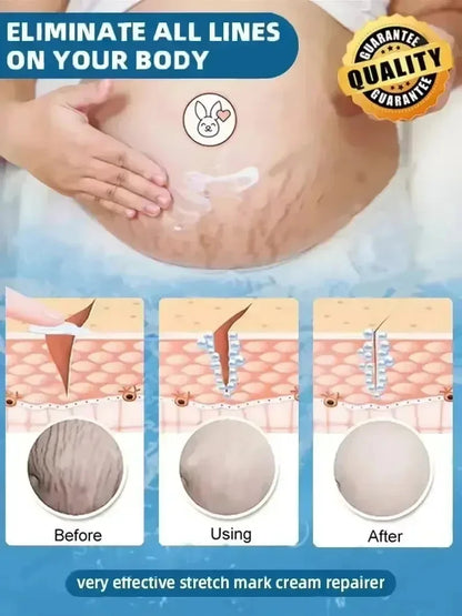 Stretch Marks Remover Cream Pregnancy Maternity Body New Old Stretch Remove Marks Lifting Firming Increase Elasticity Of Skin